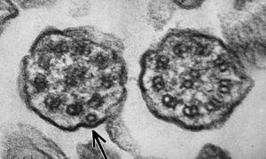 F,5y. | immotile cilia syndrome - trachea F,5y. | immotile cilia syndrome - trachea